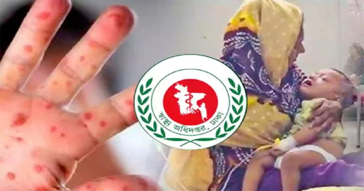 ২৪ ঘণ্টায় হাম ও উপসর্গে আরও ৫ শিশুর মৃত্যু