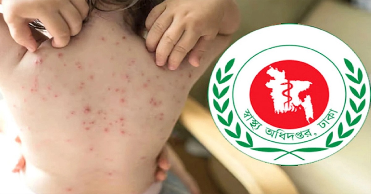 হাম ও হামের উপসর্গ নিয়ে আরও ৯ শিশুর মৃত্যু