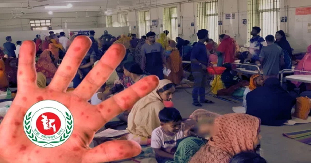 হামে আরও ২ শিশুর মৃত্যু, নতুন উপসর্গ ১,২৩৫ জনের মধ্যে