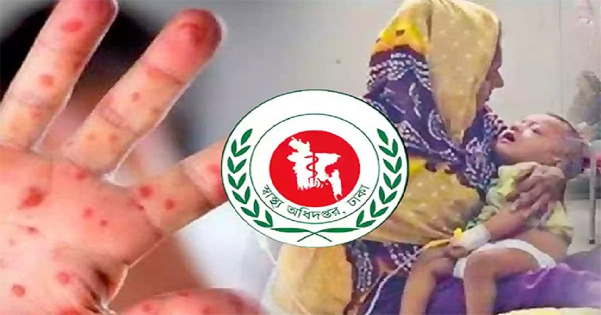 হামের উপসর্গে আরও ৪ শিশুর মৃত্যু, আক্রান্ত বাড়ছে